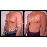 Gynecomastia Surgery