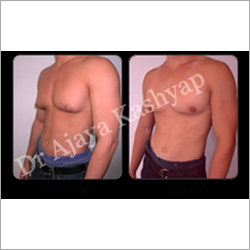 Male Chest Reduction