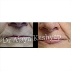 Smile Rejuvenation