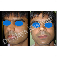 Lip Augmentation