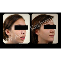 Chin Augmentation Surgery