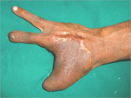 Medical Treatment For Blast Injury