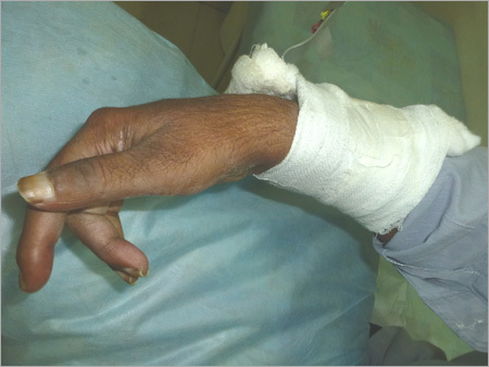 Medica Solution For Blast Injury