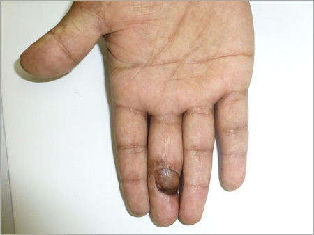 Medica Solution For Blast Injury