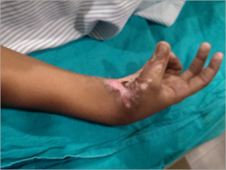 Medica Solution For Blast Injury