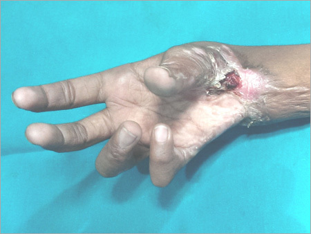 Medical Services For Blast Injury