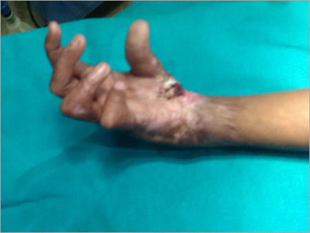 Medical Solution For Surgical Injury