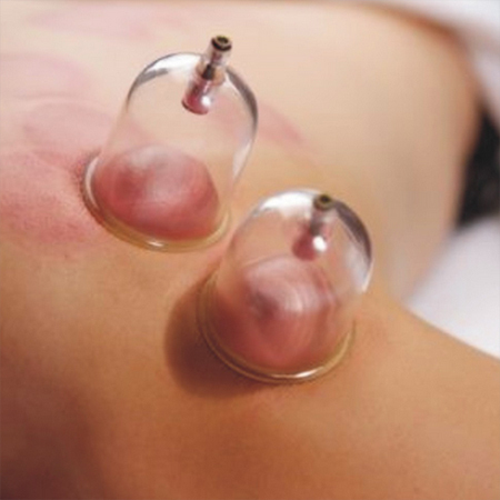 Cupping Therapy