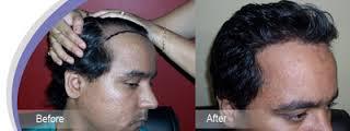 Hair Microwefting Treatment