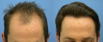 Hair Transplant
