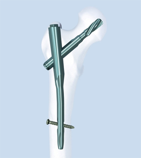 Antirotation Proximal Femoral Nail