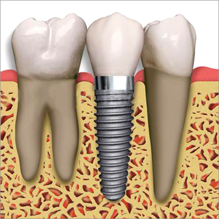 Dental Implants By BANSAL DENTAL HOSPITAL (Creating healthy smiles since 1999)
