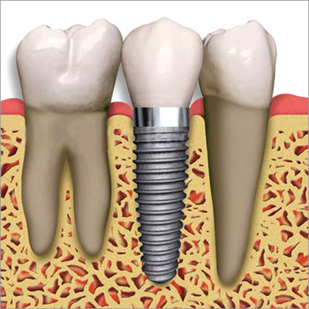 Dental Implant Surgery