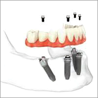 All on 4 Dental Implants