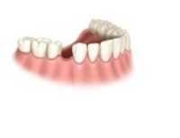 Dental Implants for Missing Single Tooth