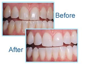 Laser Teeth Whitening in One Hour