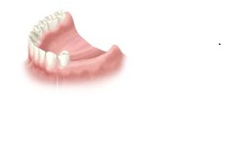Dental implants for missing several teeth