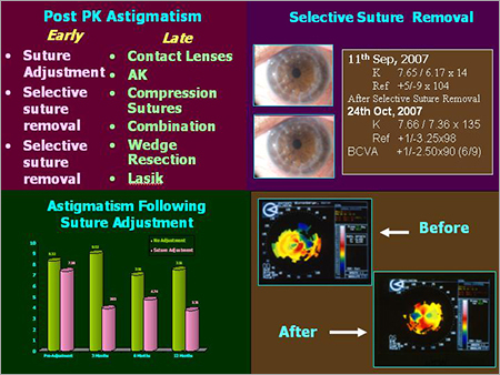 Post PK Astigmatism