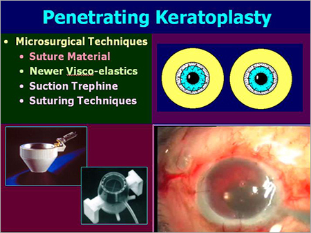 Pediatric Penetrating Keratoplasty