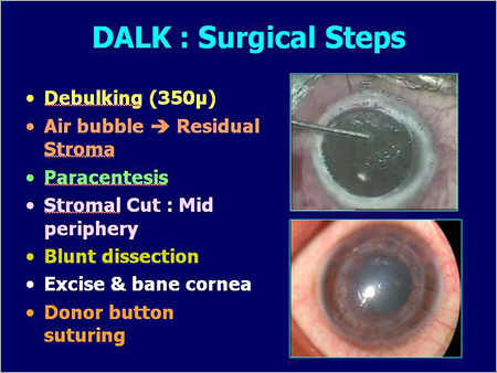 Dalk Surgical Steps