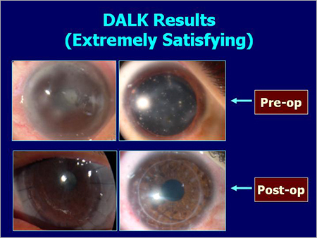 DALK Results