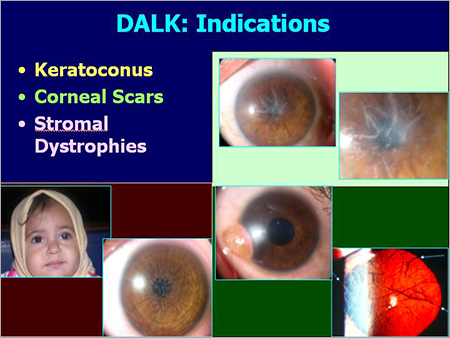 Dalk Deep Anterior Lamellar Keratoplasty