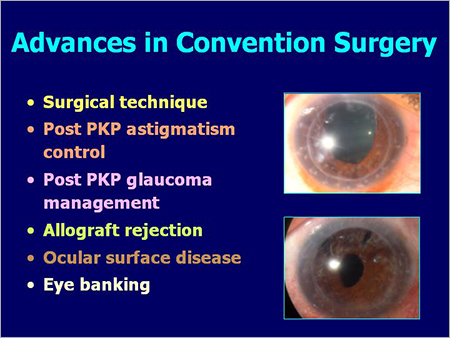Advances in Corneal Surgery