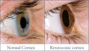 Keratoconus Treatments