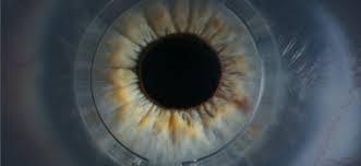 Intracorneal Ring Segments