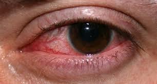 Dry Eye Treatment
