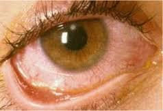 Corneal Ulcer Treatment