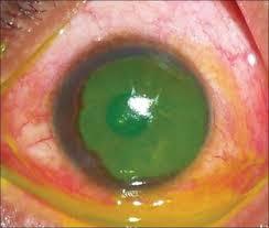 Chemicals Injuries Treatment