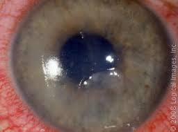 Corneal Injuries