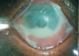 AMT- Amniotic Membrane Transplant