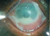 AMT- Amniotic Membrane Transplant 
