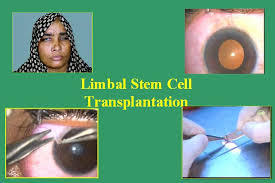 LSCT-Limbal Stem Cell Transplants