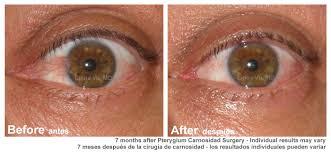 Pterygium Surgery