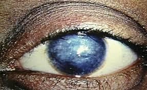Corneal Blue -Cyan Crystal Tissue Adhesive