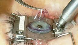 LASIK-Laser in-situ Keratomileusis