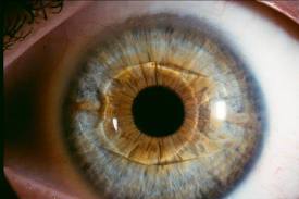 Phakic Intraocular Lens