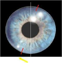 Soft Toric Contact Lens