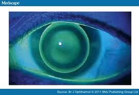 Rose K Contact Lenses