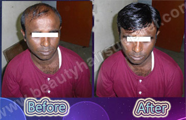 Hair Clinic in Kolkata