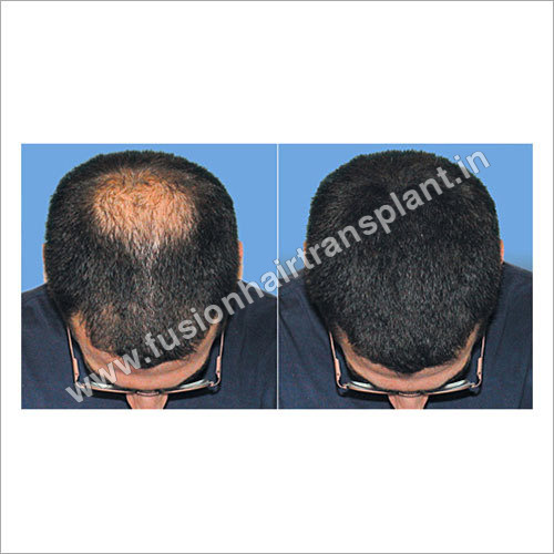 Natural Hair Bonding in Delhi India