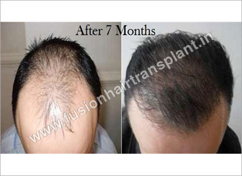 Hair Transplant in Delhi India