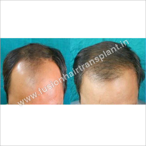 Hair Transplant in Delhi