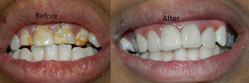 Dental Veneer and Componeers Treatment