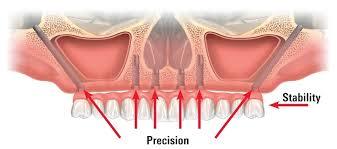 Zygoma Implant Treatment