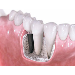 Dental Implant Services