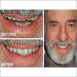 Denture Implant